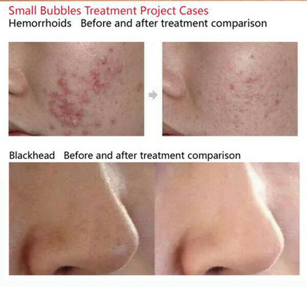 Water Peel Peeling Deep Face Cleansing Hydro Dermabrasion Hydra Facial Machine