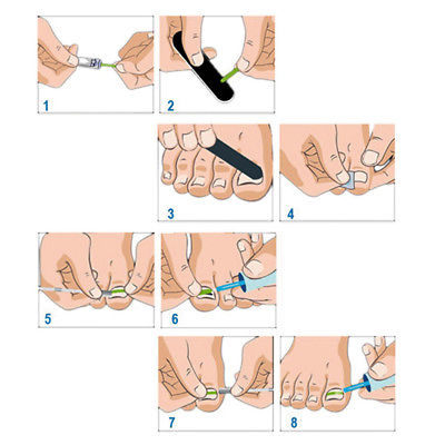 Ingrown Toenail Straightening Correction Tools Foot Nails Pasters Kit Flower