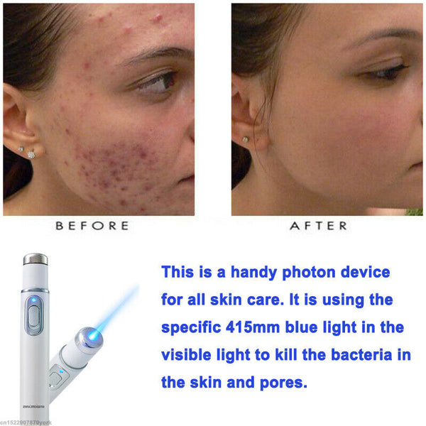 Medical Blue Light Therapy Laser Pen Scar Acne Varicose Removal Veins Treatment