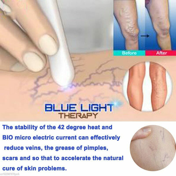 Medical Blue Light Therapy Laser Pen Scar Acne Varicose Removal Veins Treatment